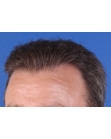 After Hair Transplant&nbsp;Front